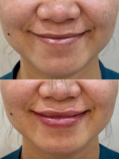 Lip enhancement is an art. My focus is on restoring balance, symmetry, and hydration, not just adding volume. This subtle transformation enhances the natural lip curve for a youthful and defined result, proving that less is often more.