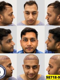 Hair Transplant Surgery