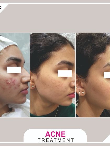 A multi-session acne treatment journey. You can see the progression from active, inflamed acne to clearer, calmer skin with reduced scarring over time.