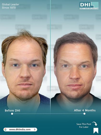 A frontal before and after showing the 4-month progress of a client's DHI hair transplant. Even at this early stage, the new hairline is taking shape and the density is visibly improving.