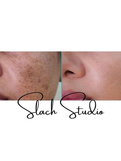 This image clearly shows the reduction of dense pigmentation around the nose and cheek area, leaving behind clear and healthy-looking skin.