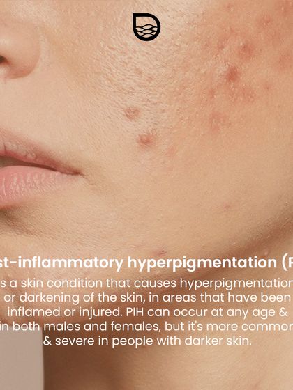 Understanding Your Pigmentation photo 11