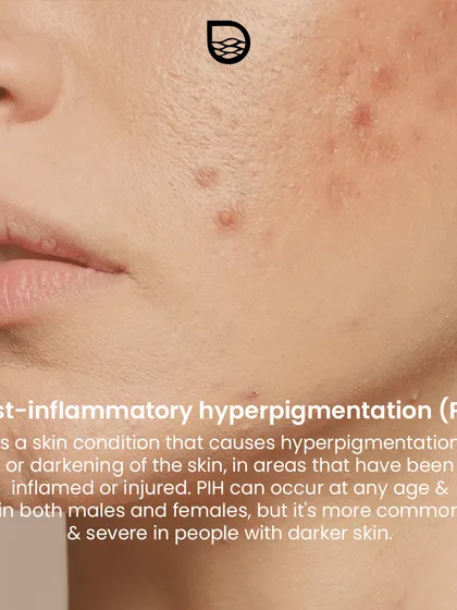 Post-inflammatory hyperpigmentation (PIH) is the darkening of the skin after it has been inflamed or injured. It is very common but can be treated effectively.