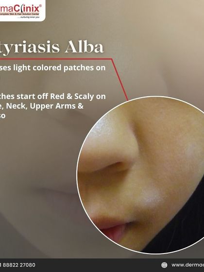This graphic describes Pityriasis Alba, which causes light-colored patches on the skin that may start as red and scaly. It is commonly seen on the face, neck, and upper arms.