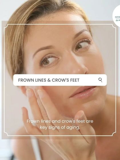 Frown lines and crow's feet are key signs of aging caused by repeated expressions. Anti-wrinkle injections like Botox can soften these dynamic lines, giving you a smoother and more serene appearance.