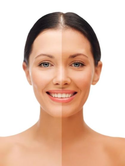 This image visualizes the effect of my skin toning treatments. I help my patients move from a tanned or uneven complexion to a brighter, more uniform skin tone using advanced, non-invasive procedures.