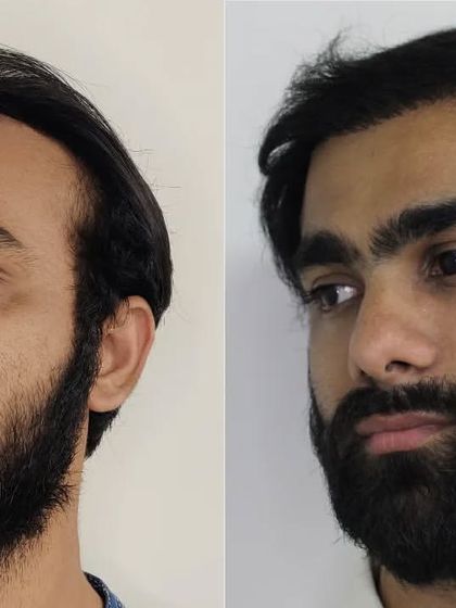 This angle highlights the new temple points and the seamless blend of the transplanted hair.