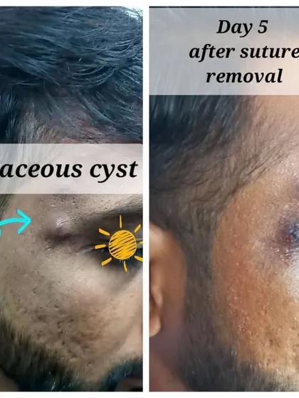 This image shows the successful removal of a sebaceous cyst from a patient's temple. The left side shows the cyst before the procedure, and the right side shows the healed area just five days after the minor excision and suture removal, with minimal scarring.