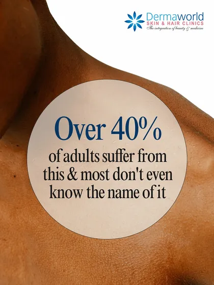 Have you ever noticed tiny, rough bumps on your arms or legs, often called 'strawberry skin'? This is likely Keratosis Pilaris, a very common condition affecting over 40% of adults. It's manageable with the right diagnosis and treatment plan.