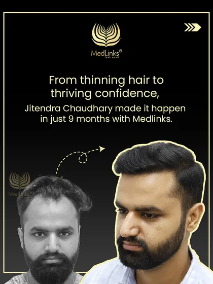 From thinning hair to thriving confidence, this collage shows Jitendra's incredible 9-month transformation with us.