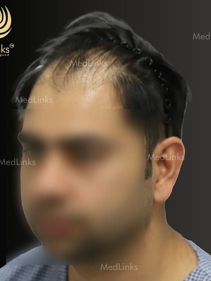 The side profile before the procedure.