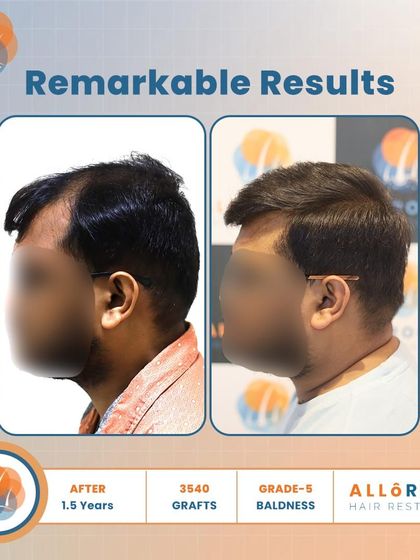 Remarkable results after 1.5 years for a Grade 5 baldness case. Using 3540 grafts, we achieved a dense and natural-looking outcome, as shown in these detailed before-and-after shots.