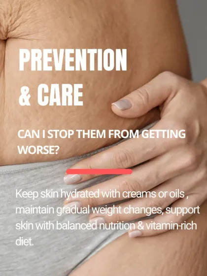 While you can't always prevent stretch marks, you can care for your skin to minimize them. Keeping skin hydrated, maintaining gradual weight changes, and supporting skin with a balanced, vitamin-rich diet can help.