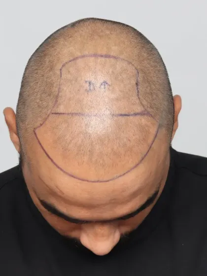 The process begins with precise planning. Here you can see the pre-marked area for a Grade 5A case before we implanted 3,800 grafts.