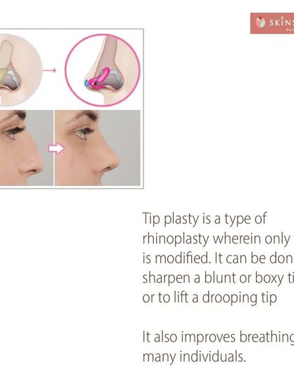 Not every rhinoplasty requires changing the entire nose. Tip plasty is a specific procedure focused only on modifying the nasal tip, whether it's to sharpen a blunt tip, refine a boxy shape, or lift a drooping tip.