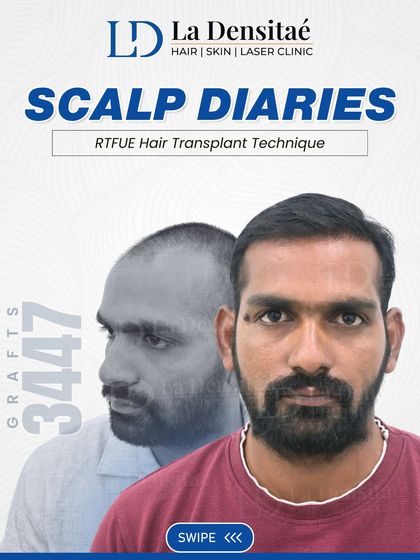 This is the story of Durugesh's transformation, made possible with 3,447 grafts. The treatment was planned with care and executed with my RT-FUE technique, and you can see the difference not just in his hair, but in how he carries himself.
