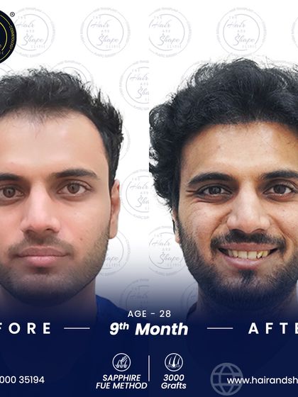 A smile that says it all. This 9-month result from a 3000-graft Sapphire FUE procedure shows a happy patient with a restored hairline and renewed self-assurance.