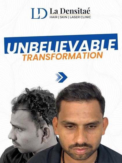 This transformation isn’t just about hair; it’s about getting you back. This before-and-after shot shows a dramatic change, restoring not just a hairline but also the confidence that comes with it.