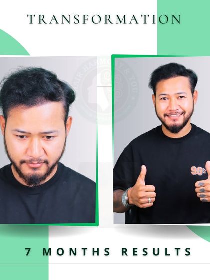 Seven months post-procedure, and this client is all smiles. His before and after photos show a remarkable improvement in hair density and a stylish new look.