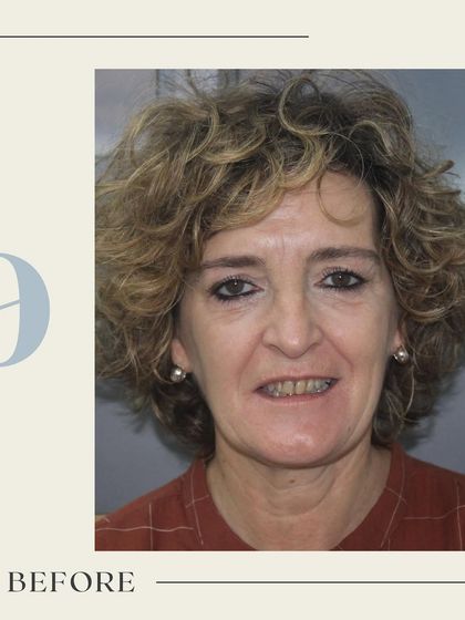 This is the "before" image of a client who felt hesitant to smile. It serves as the starting point for a journey toward a healthier, more confident appearance, addressing concerns with alignment, color, and shape.