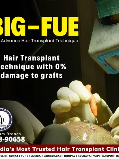 This image shows my specialized BIG-FUE technique in action. The key is to ensure almost zero damage to the hair grafts during extraction and implantation. This precision is vital for achieving the highest density and best possible results.