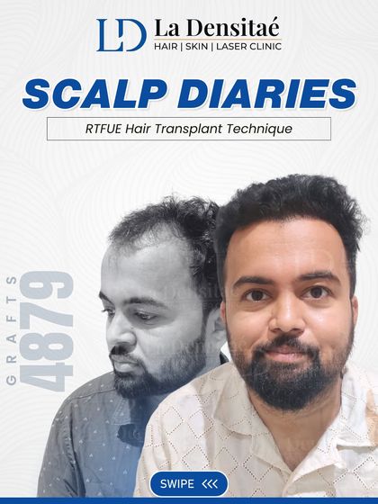 This post documents Shardul Kamthe's journey with 4,879 grafts. His story is a reminder that even complicated cases of hair loss can be transformed when you are in expert hands.