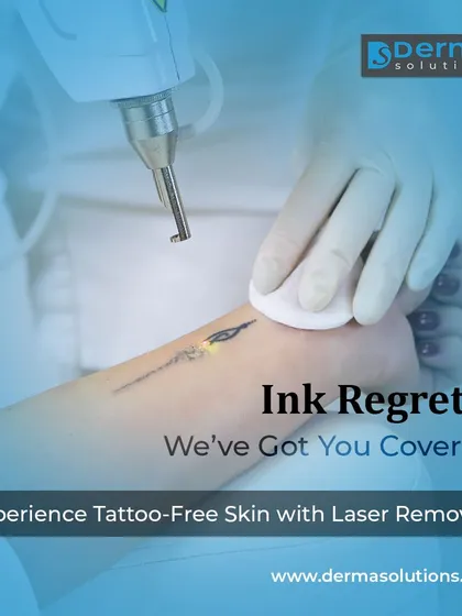 Whether your tattoo is large or small, the goal is a clean slate. Here, I am performing a laser removal procedure on a delicate tattoo on the foot. My approach ensures that only the ink is targeted, preserving the health of the surrounding skin.
