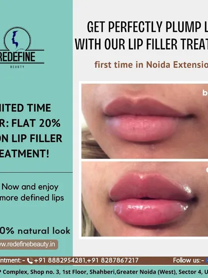 This is a great example of how lip fillers can create a fuller, more defined shape while still looking completely natural. I achieved this plump, hydrated look for a client who wanted to enhance her lips, and the results are immediate.