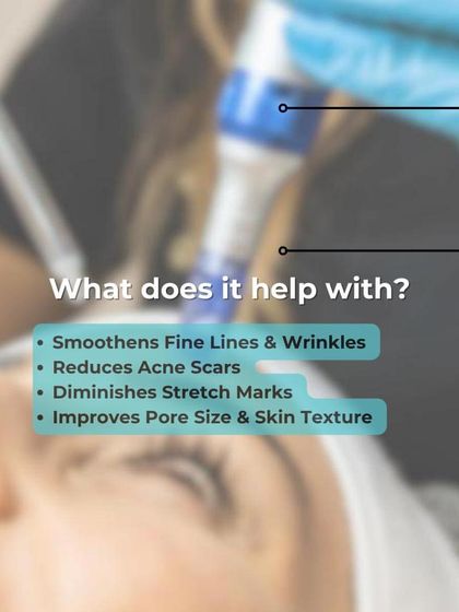 This infographic details the benefits of Dermapen microneedling. It effectively smoothens fine lines and wrinkles, reduces acne scars, diminishes stretch marks, and improves pore size and skin texture by stimulating collagen and elastin.