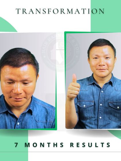 Seven months can make a world of difference. This client is proudly showing his progress, with a full head of hair that he can style with confidence. His satisfaction is my ultimate goal.