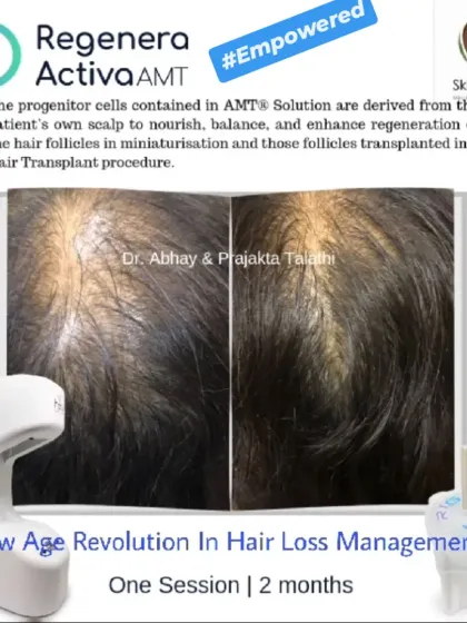 This before-and-after photo shows the powerful results of one Regenera Activa session over two months. The treatment helped empower this patient by restoring hair volume and reducing the visibility of the scalp.