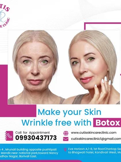 A clear before-and-after comparison demonstrating the effectiveness of our Botox treatment for reducing deep-set wrinkles and fine lines, resulting in a significantly smoother and more youthful complexion.