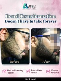 Facial Hair Transplant