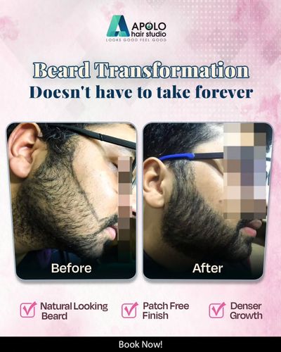 Facial Hair Transplant