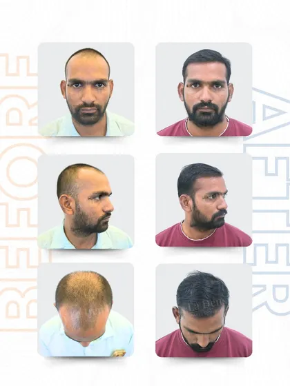 This is what a complete transformation looks like. For Mr. Durgesh, I used the RT-FUE Sapphire technique to place 3,447 grafts. We addressed the receding hairline, the thinning sides, and the crown area to create a full, natural look from every angle.