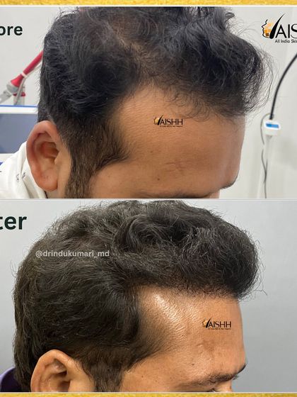 A side-angle view of the same patient, demonstrating how the new hairline integrates flawlessly with the temporal points for a completely natural look.