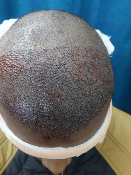 An overhead view of the scalp immediately after the FUE grafts have been implanted. The density of the implanted follicles is key to achieving a full look once the hair grows in.