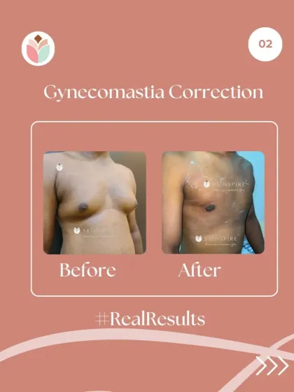 This before and after image shows a gynecomastia correction. For many men, this condition is caused by hormonal factors, not a lack of exercise. Our surgical procedure removes the glandular tissue and excess fat to create a flatter, more masculine chest contour.