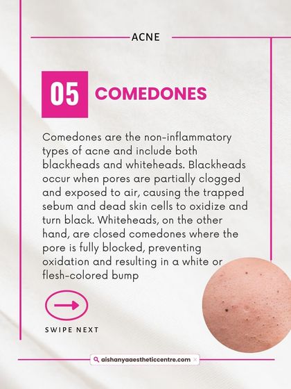 Comedones are the non-inflammatory types of acne, including blackheads and whiteheads. They form when pores get clogged with oil and dead skin cells, and are often the starting point for more severe acne.