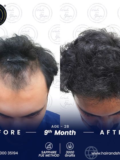 Looking at the top of the head, you can see the significant fill and natural texture achieved 9 months after the Sapphire FUE transplant.