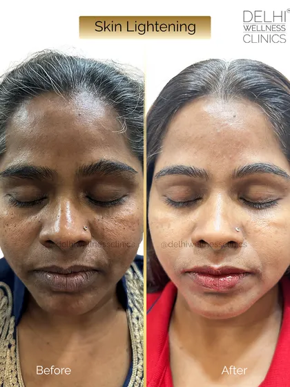 This before and after photo shows the full-face result of our skin lightening protocol, which targets dullness and uneven tone for a radiant finish.