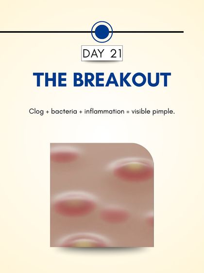 Day 21: The combination of a clogged pore, bacteria, and inflammation results in a visible pimple on the skin's surface. This is the stage where most people start to notice the breakout.