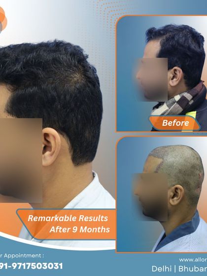Remarkable results after just 9 months. This series shows the before, post-op, and after stages, highlighting the efficiency and effectiveness of the procedure.