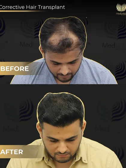 This top-down view shows the significant improvement in density and coverage after our corrective procedure. We specialize in these complex cases that require precision and experience.