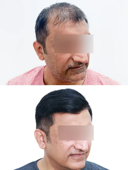 This view captures the restored density and how the new hair frames the face, creating a more balanced and youthful aesthetic.