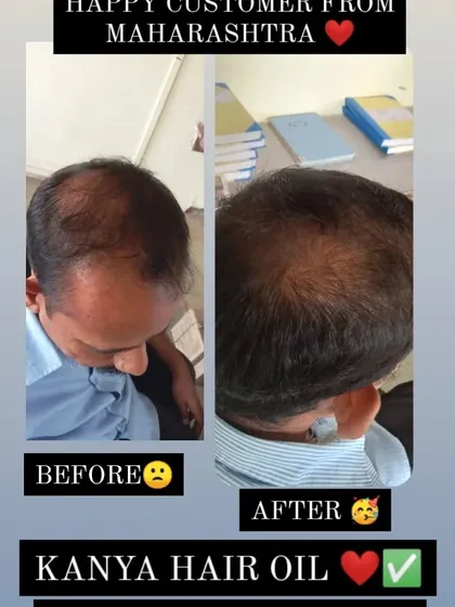 I get many questions about hair regrowth, especially for pattern baldness. This is a real customer result from Maharashtra, showing visible improvement. My Kanya Hair Oil works by nourishing the scalp and stimulating follicles to support natural hair regrowth.