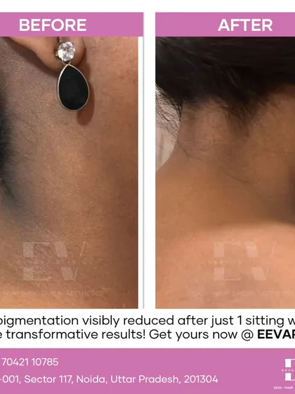 Dark pigmentation on the neck is a common concern, but it's something we can effectively treat. This before and after image shows a visible reduction in neck pigmentation after just a single sitting at our clinic, demonstrating the power of a targeted, professional approach.