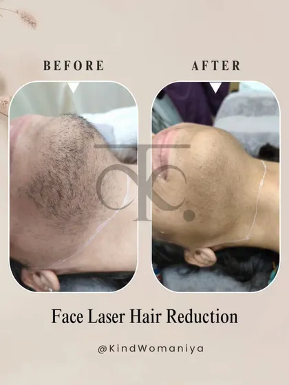 See the clear difference for yourself. This before and after shows the significant reduction in facial hair, leading to smoother skin and renewed confidence for our client.
