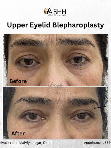 A close-up before-and-after of an upper eyelid blepharoplasty. This minor surgery removes excess skin from the upper eyelid, resulting in a brighter, more alert appearance.