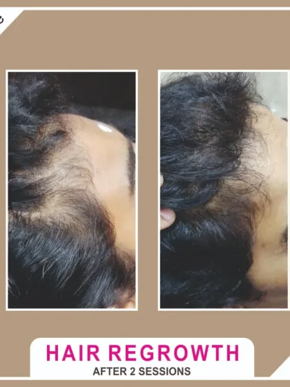 Results can appear faster than you think. This client achieved visible hair regrowth and a fuller appearance after just two sessions, showing how quickly our targeted therapies can begin to work.